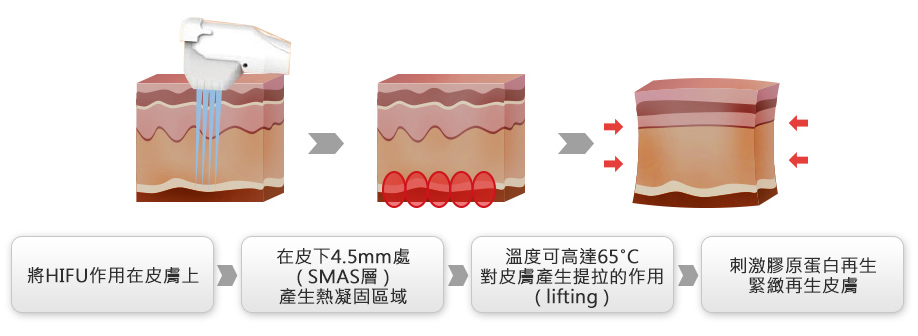 音波拉提